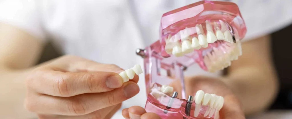 chirurgien dentiste protheses l isle adam chirurgien dentiste protheses l isle adam Implants dentaires Dr Ludovic Zeitoun - Chirurgien-dentiste à L'Isle-Adam