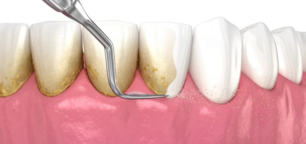 surfacage radiculaire detartrage Soins des gencives Dr Ludovic Zeitoun - Chirurgien-dentiste à L'Isle-Adam