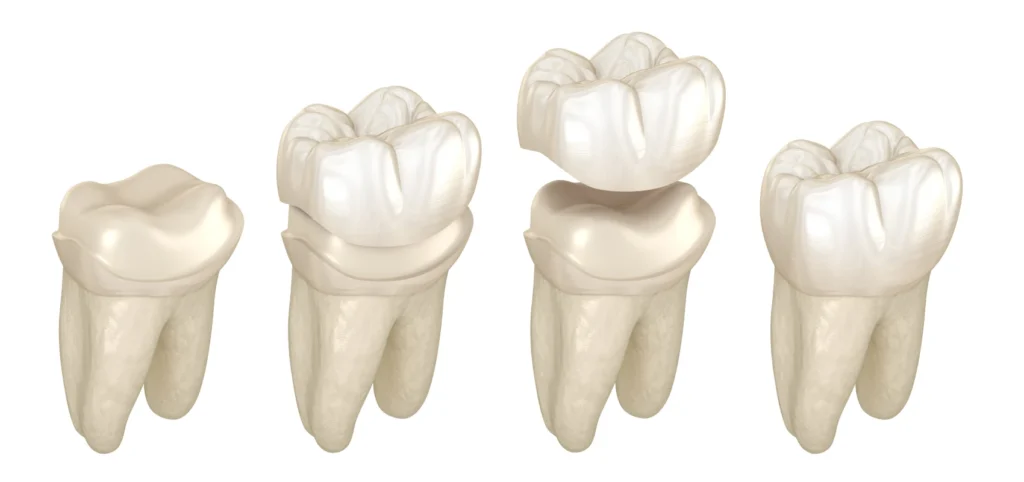 dr ludovic zeitoun implants l isle adam dr ludovic zeitoun implants l isle adam Soins des caries Dr Ludovic Zeitoun - Chirurgien-dentiste à L'Isle-Adam