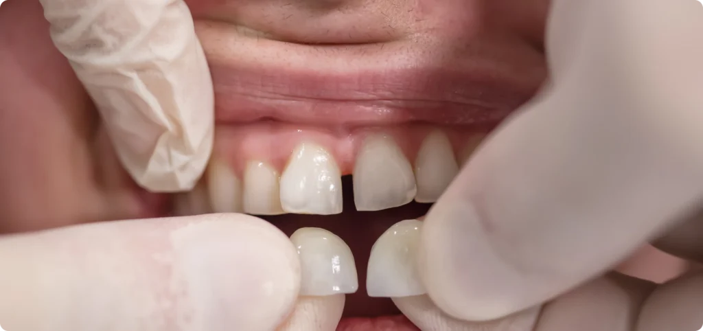 soins gencives Les facettes : l’esthétique du sourire Dr Ludovic Zeitoun - Chirurgien-dentiste à L’Isle-Adam