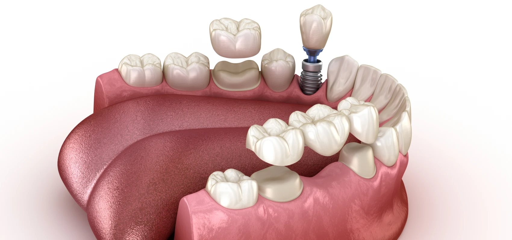 implants dentaires protheses isle adam Prothèses dentaires Dr Ludovic Zeitoun - Chirurgien-dentiste à L'Isle-Adam